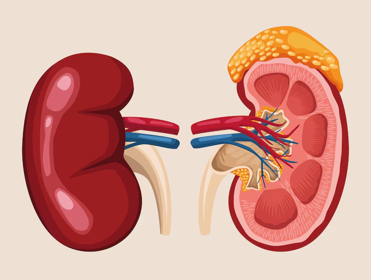 किडनी स्टोन (Kidney Stone) क्या है?