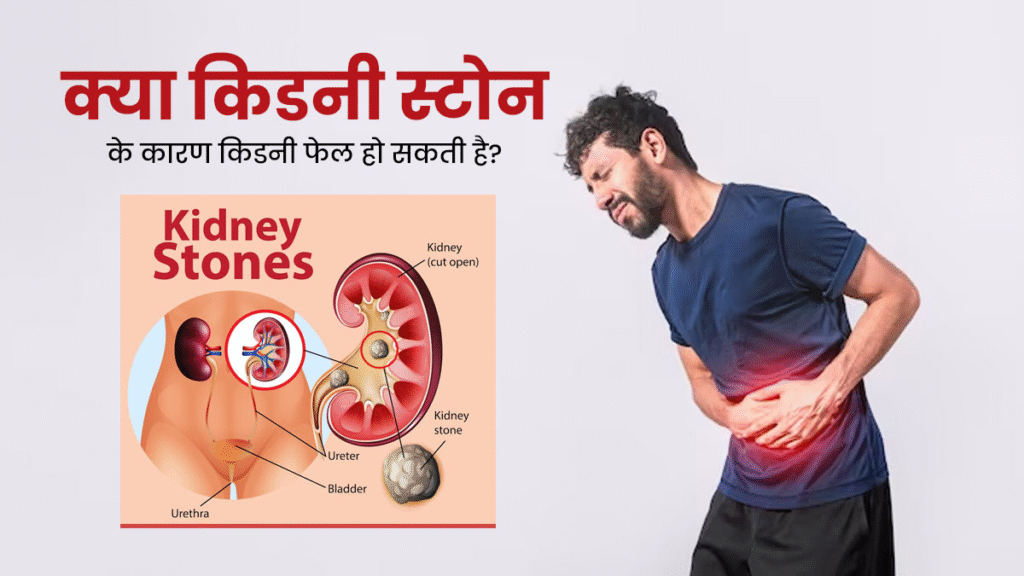 किडनी स्टोन के लक्षण