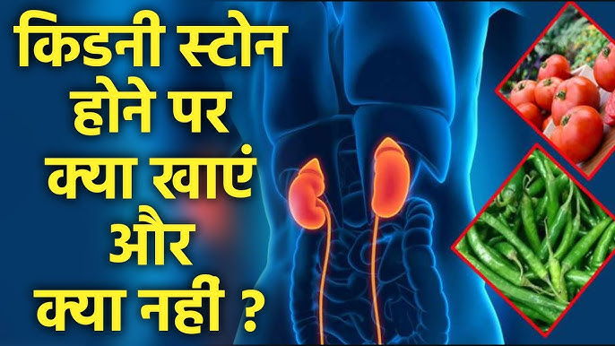किडनी स्टोन में क्या खाएं और क्या न खाएं